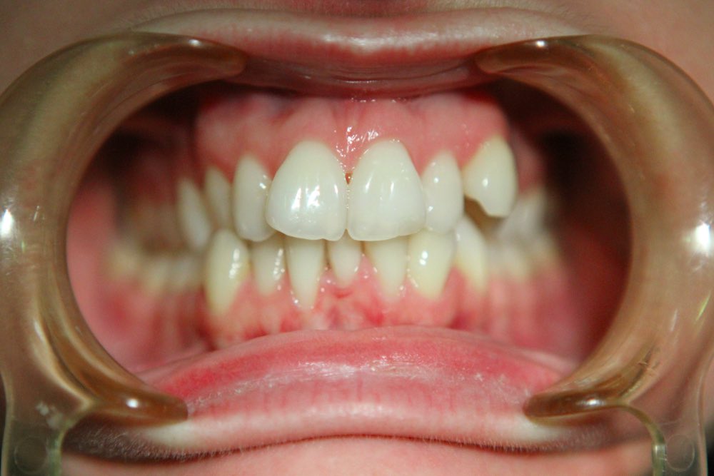 aparat ortodontyczny 6 dentim clinic katowice