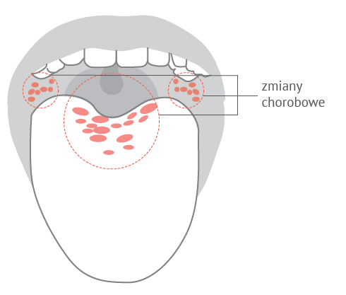 Zmiany błony śluzowej jamy ustnej