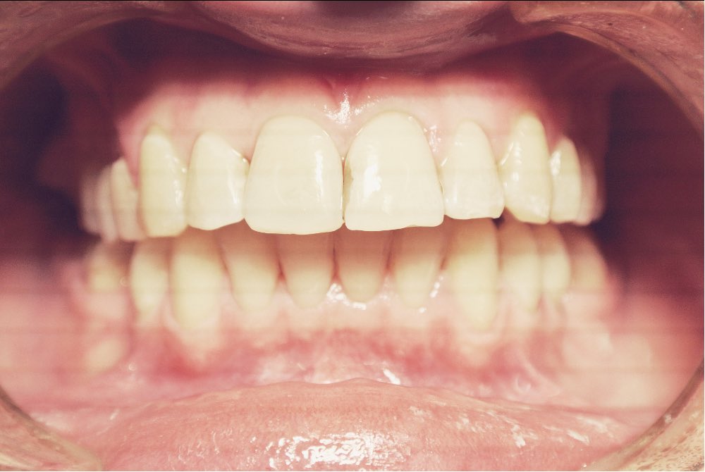 aparat ortodontyczny 1a dentim clinic katowice